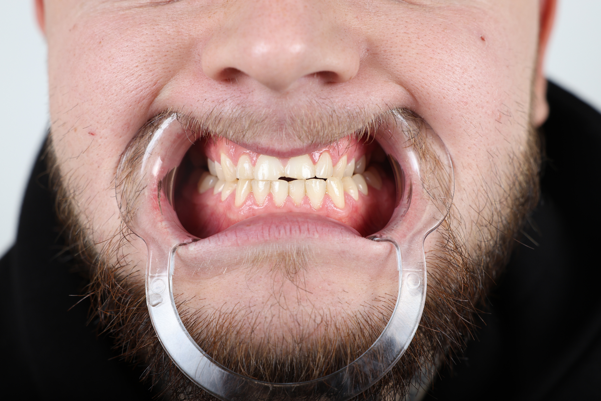 Before Zirconia Crown Treatment